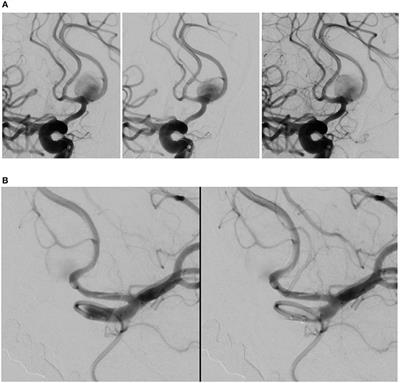 Silk Vista Baby Is a Safe and Technically Feasible Flow Diverting Stent for Distal Aneurysm Treatment